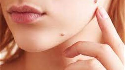 ما هي ثآليل البشرة؟.. وأنواعها وأسبابها والعلاج