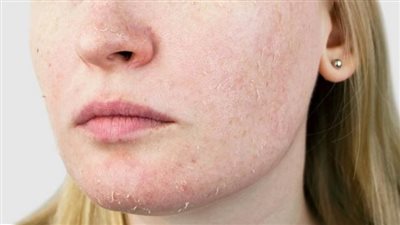 اعرفي ماهي عيوب ومميزات بشرتك الجافة 