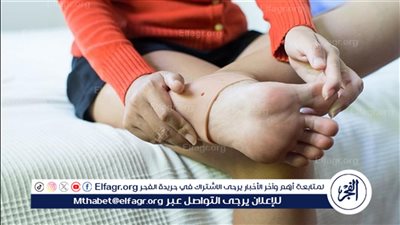 علاج الشوكة العظمية بالأعشاب.. طرق طبيعية للتخفيف من الألم والتورم