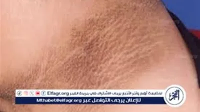  ماسك لإزالة سواد الرقبة في المنزل