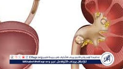 التعامل مع حصوات الحالب والمثانة: دليل شامل للصحة البولية