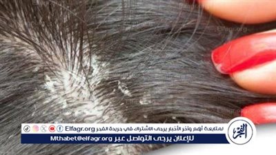  فهم الفشرة المزمنة: أسبابها وتأثيرها 