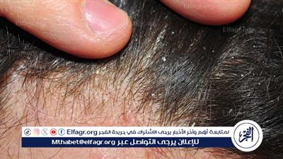  فهم الفشرة الموسمية: الأسباب والعلاج 