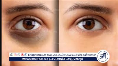 وداعًا للهالات السوداء.. ماسك سحري لإزالة الهالات السوداء في دقائق