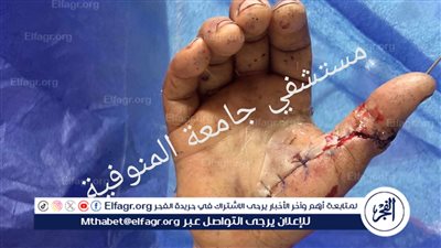 استرجاع كف مريض بعد انفصاله تمامًا بمستشفى الجامعة بالمنوفية 