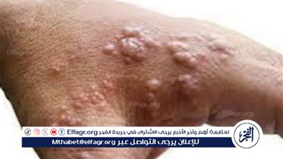 تحذير عالمي: اكتشاف سلالة جديدة من جدرى القرود يثير القلق حول احتمال تحولها إلى وباء