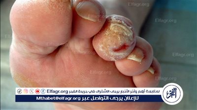 مرض القدم السكري: الأعراض والعلاج والوقاية 