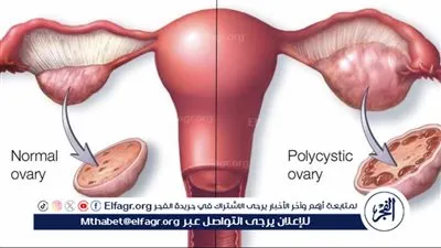 متلازمة تكيس المبايض.. العوامل المسببة وأهمية التشخيص المبكر