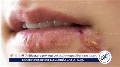 لقاح الهربس 