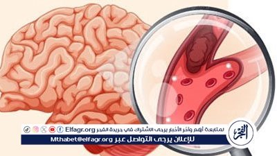 كورونا وتكميم المعدة.. استشاري يكشف مفاجأة عن أسباب الإصابة بـ جلطة المخ