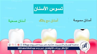 أسباب تسوس الأسنان وكيفية الوقاية منها