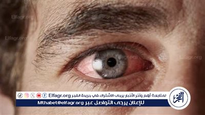 تعرف علي الفئات الأكثر عرضة للإصابة بالرمد الربيعي