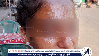 عاجل|النيابة تحيل الموظفة المتهمة بتشويه وجه طالبة في مدرسة فيصل للمحاكمة