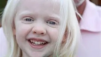 في اليوم العالمي له.. كل ما تريد معرفته عن مرض المهق 