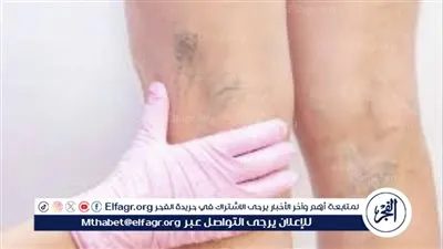 كيف تجنب الإصابة بدوالي الساقين: عادات يومية تحتاج إلى تغيير