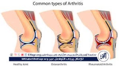 بديل مذهل لجراحة استبدال الركبة بالكامل