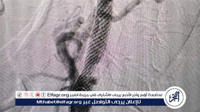 فريق طبي بمستشفى ملوي التخصصي في المنيا ينقذ مريض من شلل رباعي (تفاصيل)