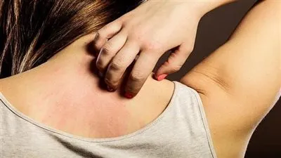 نصائح ووصفات منزلية للتخلص من الحكة خلال فصل الصيف