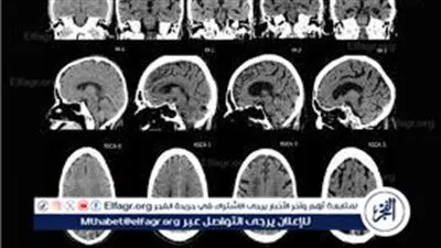 ضمور المخ.. درجات الإصابة به وطرق علاجه