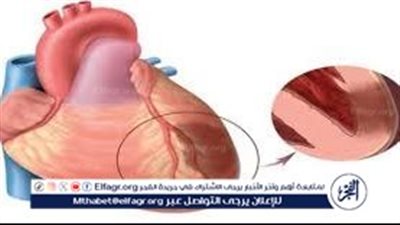 احتشاء عضلة القلب.. الأسباب والأعراض والعلاج
