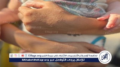 عاجل - مدير مستشفى كمال عدوان: انتشار أمراض جلدية خطيرة تهدد حياة أطفال غزة (تفاصيل)