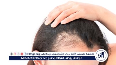 الصلع الوراثي عند السيدات: الأسباب وطرق العلاج