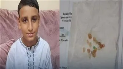 طفل يتبول أحجار كريمة.. أطباء يكشفون الحقيقة كاملة (فيديو وصور)