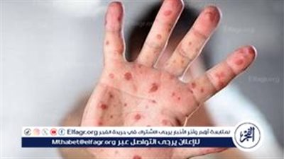 فيروس جدري القرود: معلومات شاملة