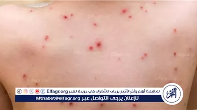 وزارة الصحة والسكان تعلن عن إجراءات وقائية جديدة لمواجهة مرض جدري القردة «M Pox»