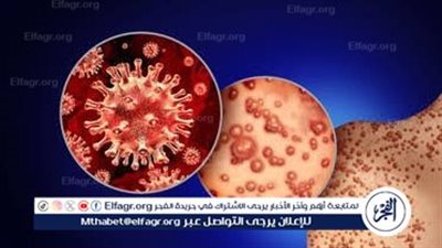 مرض جدري القردة (mpox).. الأعراض والعلاج والوقاية