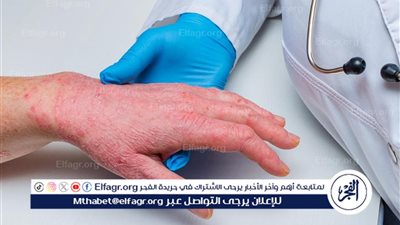 جدري القرود.. 