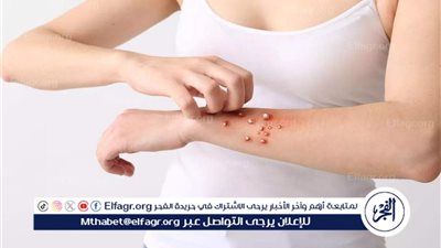 هل جدري القرود مميت؟.. معلومات مهمة عن السلالة الجديدة: الأسباب والأعراض والعلاج والوقاية