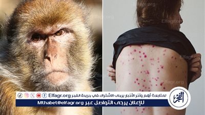 فيروس جدري القردة: تطوراته وأثره على الصحة العامة