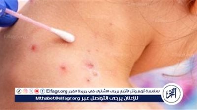 التعرف على أعراض جدري القردة وكيفية التعامل معها