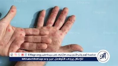 الصحة الكينية: تسجيل إصابة ثانية في البلاد بجدري القردة