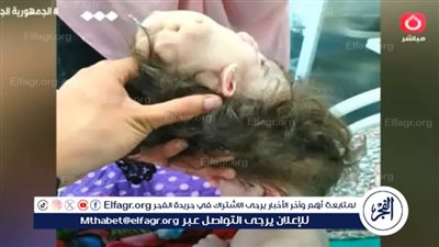 تفاصيل عملية فصل توأم ملتصق من الرأس.. استغرقت 10 ساعات