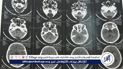 مستشفى سوهاج الجامعي تنجح في استئصال 