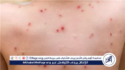 أستاذ أوبئة يوضح حقيقة ظهور جدري القردة بمصر وأهم أعراض الإصابة (فيديو)