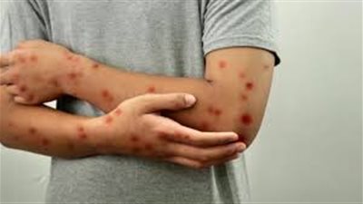 جدري القردة.. نظرة شاملة عن الأسباب وكيفية العلاج