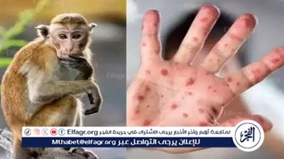 جدري القرود.. أعراضه ومدى خطورته وكيفية علاجه