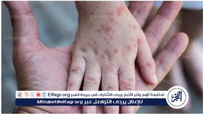 الرابطة الطبية الشرق أوسطية توضح أعراض جدري القردة وسبب الانتشار (فيديو)