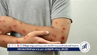 عاجل- منظمة الصحة العالمية تعتمد أول لقاح ضد جدري القردة