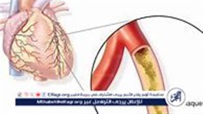 مرض الشريان التاجي: الأعراض والأسباب والعلاج