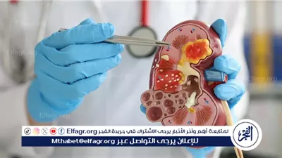 حصوات الكلى: أسبابها، أعراضها، وطرق الوقاية