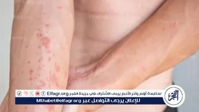  الرابطة الطبية الأوروبية: 95 % من انتشار الأرتيكاريا يأتي في الأجواء الباردة