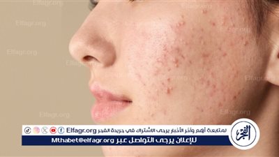 حب الشباب: الأسباب والعلاج وطرق الوقاية