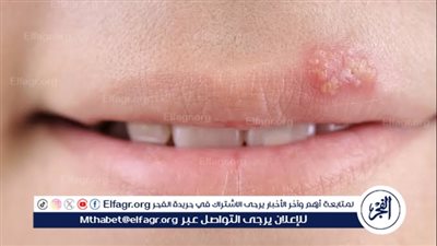 فيروس الهربس البسيط.. أسبابه وأعراضه وعلاجه 