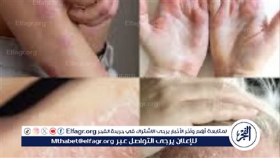 مع اقتراب فصل الشتاء.. كل ما تحتاج لمعرفته عن مرض الأكزيما
