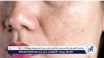 العناية بالبشرة الدهنية: نصائح وإرشادات فعالة