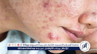 حب الشباب: أسبابه، أنواعه، وطرق العلاج